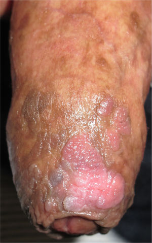 Lesions before the first session of photodynamic therapy.