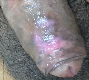 Lesions before the last session of photodynamic therapy.