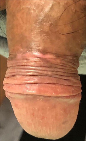 Four months after the end of treatment with photodynamic therapy.