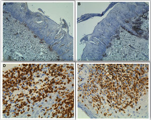 Histological images showing (A) CD4-, (B) CD8-, (C) cytoplasmic CD3+, and (D) granzyme-B+ staining.