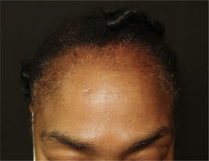 Frontal capillary hypodensity.