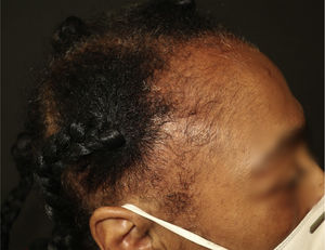 Temporal capillary hypodensity associated with a high-traction hairstyle.