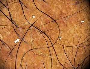 Hair casts in the region proximal to the shaft (arrow). Multiple empty follicular orifices (>) and fine hairs (*). Some dystrophic hairs (×). A fine pigmented reticulum can be observed on the interfollicular skin; this sign is present in dark phototypes.