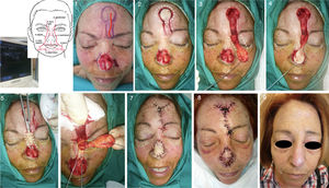 Design, realization, and postoperative outcome of a paramedian forehead tunneled island flap with arterial pedicle (supratrochlear artery) (Patient 2). 1. After BCC resection from the tip of the nose with Mohs surgery, the supratrochlear artery with greatest flow is located using Doppler mode ultrasound (in this case, the left artery) and a paramedian forehead tunneled island flap is designed. 2-4. Cutting out the island and epithelized pedicle, checking that it is long enough to reach the recipient area. 5. Tunneling the area of skin between the recipient and donor areas. 6. Deepithelization of the pedicle to subsequently pass it through the tunnel. 7. Direct closure of both areas. 8. Partial distal necrosis of the flap on the third day after the operation (patient was a heavy smoker). 9. Outcome 1 year after the procedure.