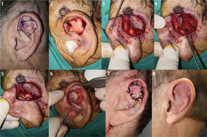 Design, realization, and immediate and late postoperative outcomes of retroauricular tunneled island flap or revolving door flap (Patient 12). 1 and 2. Design and resection with 3-4 mm margins of BCC in antihelix, exposure of the underlying cartilage. 3 and 4. Elaboration of the retroauricular island of skin. 5 and 6. Tunneling towards the anterior auricular area through cartilage and transposition of the retroauricular island of skin towards the anterior auricular area. 7 and 8. Direct closure of both areas, immediate postoperative outcome and after 5 months.