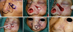 Left paranasal tunneled island flap to repair surgical defect on the tip of the nose (Case 4). 1. Design and resection of BCC with 4 mm margins and design of the flap. 2 and 3. Elaboration of the subcutaneous pedicle until achieving sufficient length to reach the recipient area. 4. Tunneling of the area between the 2 regions to subsequently pass the flap through the tunnel. 5. Direct closure of both areas. 6. Outcome 5 months after surgery.