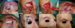 Supraciliary tunneled island flap to repair a subciliary defect (Patient 1). 1. Subciliary ulcerated BCC; the tumor is resected with 3 mm margins and an island flap designed in the supraciliary area. 2 and 3. Elaboration of the island of skin and dissection of the subcutaneous pedicle. 4 and 5. Tunneling of the area between the 2 defects to subsequently pass through the tunnel with collagen, bringing the island of skin to the original defect. 6, 7, and 8. Immediate postoperative outcome and after 3 months, preserving ciliary structure and functionality of the upper eyelid.