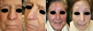 Postoperative follow-up in 2 patients who developed the trapdoor effect. A. In Patient 5, the trapdoor effect and protrusion of the pedicle can be seen at the nasogenian fold at 2 months after surgery. In this case, surgical correction in a second procedure was not needed. B. In Case 3, a notable trapdoor effect can be observed at 2 months after surgery. Spontaneous improvement occurred as the months went by. Excellent esthetic outcome at 24 months after the operation.