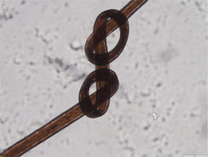 Trichonodosis. Note the 2 knots on the same hair shaft.