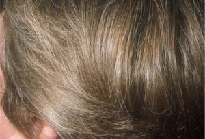 Pili annulati (ringed hair). Characteristic shiny (sequin-like) appearance.
