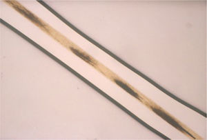 Pili annulati (ringed hair). Characteristic alternating light and dark bands in a Morse alphabet pattern.
