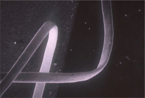 Flat-appearing hair as seen by electron scanning microscopy in a patient with woolly hair.