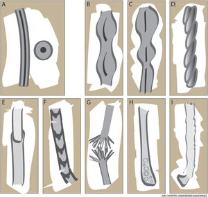 Normal hair and hair shaft disorders. A, Terminal hair with inner medulla. B, Monilethrix. C, Pseudomonilethrix. D, Pili torti. E, Trichorrhexis invaginata. F, Trichothiodystrophy. G, Trichorrhexis nodosa. H, Bubble hair. I, Loose anagen hair.