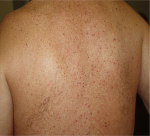 Vesicular eruption (Image credit: Dr. Alexandre do Campo Simon).