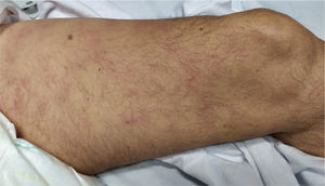 Livedo (Image credit: Dr. Ana Rodriguez Villa).