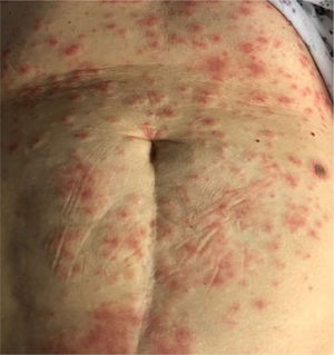 Erythema multiforme like eruption (Image credit: Dr. Zuriñe Martínez de Lagrán Álvarez de Arcaya).