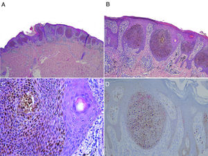 A (H&E, x10): acantosis epidérmica, con presencia de nidos de queratinocitos eosinófilos en su espesor, sin afectación ni extensión a dermis ni tejido celular subcutáneo subyacente. B (H&E, x20) - C (H&E, x40): a mayor detalle, nidos constituidos por queratinocitos eosinófilos, sin datos de atipia y marcadamente pigmentados, en ausencia de tapones córneos, con necrosis en masa y focos de diferenciación de células cuticulares. D: tinción inmunohistoquímica con HMB45 (x20): negatividad para dicho marcador, a pesar de la presencia intensa de pigmento.