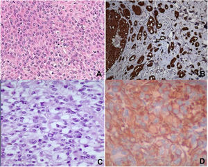 A) Tinción H-E que muestra células claras, células epitelioides y células fusiformes. B) Células fusocelulares que expresan proteína S-100. C) Tinción H-E que muestra células en huso con citoplasma claro y atipIa citológica mínima. D) Células que expresan vimentina. (Imágenes, x40.)