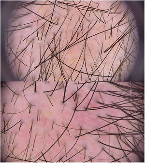 Imágenes dermatoscópicas con luz polarizada (obtenidas mediante el uso de dermatoscopio digital Fotofinder®). Panel superior: 20 aumentos. Panel inferior: 30 aumentos. Se observa alopecia focal, cabellos rotos de longitud homogénea, cabellos de recrecimiento cortos tipo velloso y puntos amarillos.