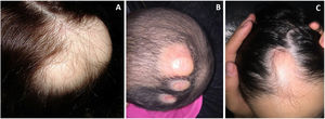A. Caso 1. Vista lateral de las placas localizadas en la región occipital del cuero cabelludo. Se observa reducción de folículos pilosos; B. Caso 2. Imagen clínica de las 3 lesiones alopécicas del cuero cabelludo; C. Caso 3. Placa alopécica congénita localizada en la región frontal.