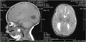 RM del caso 3. Agenesia del cuerpo calloso y dilatación de los cuernos occipitales de los ventrículos laterales (colpocefalia).