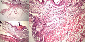 Biopsia de piel: H-E; A. Abundante tejido adiposo maduro en profundidad, que comprime la dermis superpuesta; B. Epidermis fina con hiperqueratosis ortoqueratolítica; C. Ausencia de folículos pilosos y estructuras anexiales.