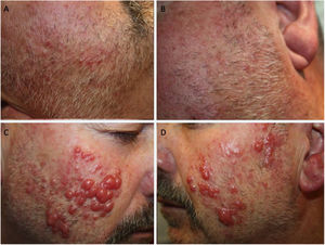 A and B, Erythematous papules on congestive skin. C and D, Firm erythematous nodule, with a tendency to coalesce on the cheeks and outer ear.