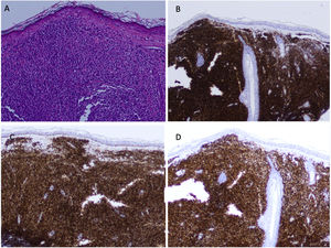 A, Biopsy of a nodular lesion. Dermal lymphocytic infiltrate composed of small lymphocytes with hyperchromatic, rounded nuclei and scarce cytoplasm (hematoxylin–eosin, 20×). B–D, Positive staining for CD20 (B), BCL-2 (C), and PAX-5 (D) of the lymphocytic infiltrate.