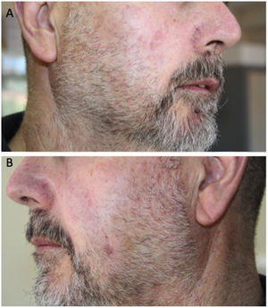 A and B, Complete clinical remission 2 years after treatment.