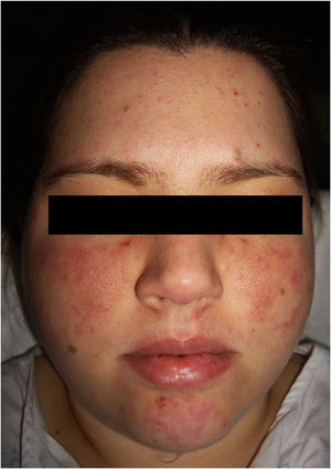 Erythematous malar plaques with papular elements on a background of telangiectasia.