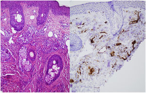 A, Hematoxylin–eosin, 10–20×. Dilated capillaries and venules, occupied by fusiform cells without atypia and with clear cytoplasm. B, CD31, 10–20×. CD31-positive and D2-40 – negative intravascular cells.