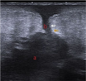 Ultrasound image.