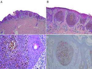 A, Acanthotic epidermis, the entire thickness of which contains nests of eosinophilic keratinocytes, without involvement of or extension to the dermis or underlying subcutaneous cellular tissue. Hematoxylin-eosin (H–E), original magnification ×10. B and C, Higher magnification images showing nests of markedly pigmented eosinophilic keratinocytes, without signs of atypia, absence of horny plugs, and mass necrosis and foci of differentiating cuticle cells (H–E, original magnification ×20 [B] and ×40 [C]). D, Image showing negative staining for HMB45 (original magnification ×20), despite the presence of intense pigmentation.