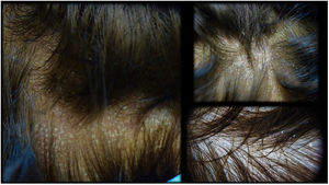 De novo pityriasiform dermatitis that appeared on the scalp of a dupilumab-treated patient 2 months after starting treatment.