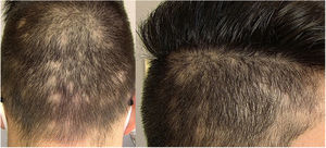 Clinical presentation of the case. Left panel: occipital region. Right panel: right parietotemporal region.