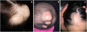 (A) Case 1. Lateral view of the plaques located on the occipital region of the scalp. Reduction of hair follicles is observed. (B) Case 2. Clinical image of the three alopecic lesions of the scalp. (C) Case 3. Congenital alopecic plaque located in the frontal region.