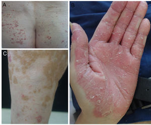 Pacientes de nuestro servicio con psoriasis por anti-PD1/anti-PDL1. A)Psoriasis en gotas. B)Psoriasis palmoplantar. C)Placas de psoriasis junto a vitíligo.