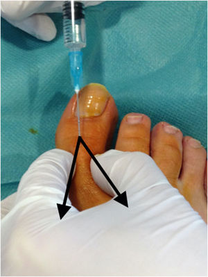 Ejecución de la técnica V.