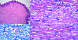Hallazgos histopatológicos. A) Proliferación fusocelular que ocupa el espesor completo de la dermis (hematoxilina-eosina, ×4). B) Detalle a mayor aumento de las células fusiformes (hematoxilina-eosina, ×40). C) Inclusiones intracelulares realzadas mediante tinción tricrómica de Masson, ×40.