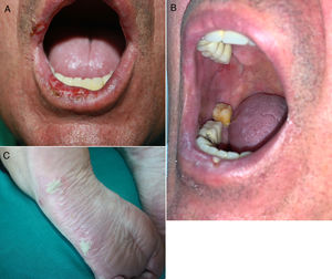 Dermatosis inflamatorias. A y B) Lesiones erosivas orales con histología de dermatitis liquenoide en un varón de 60 años con adenocarcinoma broncopulmonar estadio iv en tratamiento con durvalumab. C) Pustulosis plantar en una mujer de 68 años con adenocarcinoma broncopulmonar estadio iv en tratamiento con pembrolizumab.