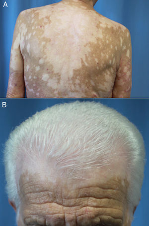 Vitíligo extenso en un paciente de 69 años en tratamiento con nivolumab por un carcinoma epidermoide de pulmón estadio iv. No existían antecedentes personales ni familiares de esta dermatosis. A) Máculas moteadas acrómicas confluentes en la espalda. B) Vitíligo del cuero cabelludo asociado a poliosis del cabello.