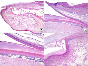 Anatomía histológica de la uña normal: A) Anatomía microscópica de la uña normal en un corte longitudinal en visión panorámica. B) A mayor aumento (×40), se observa el pliegue ungueal proximal, el epitelio de la cara ventral del mismo (eponiquio) y la verdadera cutícula, producida por el eponiquio y que se encuentra en contacto íntimo con la lámina ungueal. El eponiquio se continúa con la matriz ungueal proximal. C) A mayor detalle (×100), se observan las características crestas del epitelio de la matriz proximal, así como la banda de onicoqueratinización, que forma la estructura de la lámina ungueal. D) El aparato ungueal se continúa distalmente con el hiponiquio (×40), que consta del epitelio típico de la piel acral, con una llamativa lámina lúcida y una capa córnea gruesa.