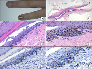 Lentigo subungueal: A) Niña de 11 años que consultó por melanoniquia del 5.o dedo de la mano izquierda. La banda de melanoniquia ocupaba la totalidad de la uña, con pigmentación del pliegue ungueal proximal (signo de Hutchinson). B) Biopsia longitudinal escisional de la uña en la que se observan (de arriba abajo) el eponiquio, la lámina ungueal con banda de onicoqueratinización, y la matriz. C) A mayor detalle (×200), se observa una proliferación melanocítica lentiginosa en los estratos basales de la matriz y abundante pigmento melánico. Hay ascenso suprabasal de algunos melanocitos, junto con múltiples artefactos de fijación. D) Detalle del epitelio de la matriz (×400) en el que llama la atención el importante aumento de pigmento. E) Detalle de la matriz (×200) con tinción de SOX10, que confirma un discreto aumento del número de melanocitos de forma salpicada en la capa basal, sin formar nidos ni filas. Puede verse ascenso suprabasal de alguna célula aislada. F) Detalle de la matriz (×400) con tinción de SOX10, que resalta un ligero aumento del número de melanocitos, separados entre sí por queratinocitos normales (este caso ha sido publicado previamente en Ríos-Viñuela et al.7).