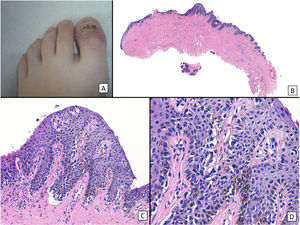 Melanoma subungueal in situ (proliferación melanocítica lentiginosa subungueal con atipia): A) Niña de 13 años derivada para completar tratamiento de lesión diagnosticada de melanoma subungueal in situ. En la exploración clínica se observa el lecho ungueal sin signos de persistencia tumoral, una vez realizada la exéresis completa del aparato ungueal. B) Visión panorámica de una biopsia transversa de la matriz en la que se adivinan ya grietas subepidérmicas y una proliferación celular intraepitelial. C) A mayor detalle (×200), se observa una proliferación lentiginosa de melanocitos atípicos, con formación de grietas entre el epitelio y la dermis subyacente, ascenso suprabasal focal de los melanocitos, y sustitución total de los queratinocitos del estrato basal por esta proliferación. D) A grandes aumentos (×400) se observan las características citológicas atípicas de la proliferación: se trata de melanocitos grandes, de núcleos picnóticos y pleomórficos, que muestran ascenso suprabasal en algunas zonas.