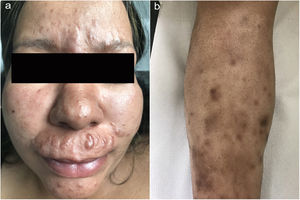 (a) Múltiples lesiones eritematosas y papulosas pigmentadas, simétricamente distribuidas e infiltración difusa de las regiones malares. (b) Lesiones nodulares subcutáneas con hiperpigmentación circundante de la espinilla.