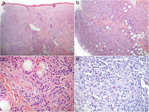 (a) Infiltrado difuso, pálido, dérmico que se expande a la zona más superficial de la dermis (zona de Grenz), compuesto predominantemente de histiocitos espumosos. (b, c) Tropismo periecrino y perineural del infiltrado. (d) Conglomerados múltiples de bacilos (globis). (a-c) H&E, (a) x 40, (b) x 100, (c) x 400; (d) tinción de Fite-Faraco, x 200.