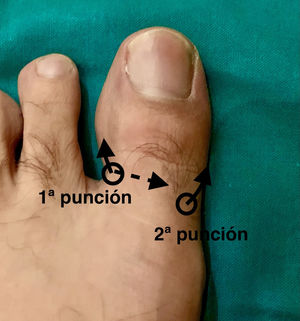 Ejecución técnica H. Primera punción en a nivel dorsal en canal peroneal dirigiendo por debajo el extensor largo del primer dedo y posteriormente hacia plantar. La segunda punción se realiza en el dorso del dedo en canal tibial dirigiendo la aguja hacia plantar.