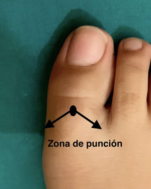 Ejecución técnica V. Se realiza una única punción y se dirige la aguja a la zona plantar por delante de la articulación metatarsofalángica en ambos laterales del dedo.