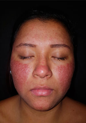 Extensive pustules over an erythematous base mainly affecting the cheeks and forehead.