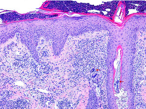 Reactive epidermal hyperplasia with collection of intracorneal neutrophils. The dermis is remarkable for the presence of a lymphohistiocytic infiltrate and vascular ectasia, together with figures suggestive of Demodex folliculorum (arrows) (hematoxylin–eosin, ×20).